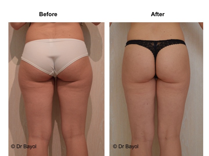 chirurgie liposuccion lausanne