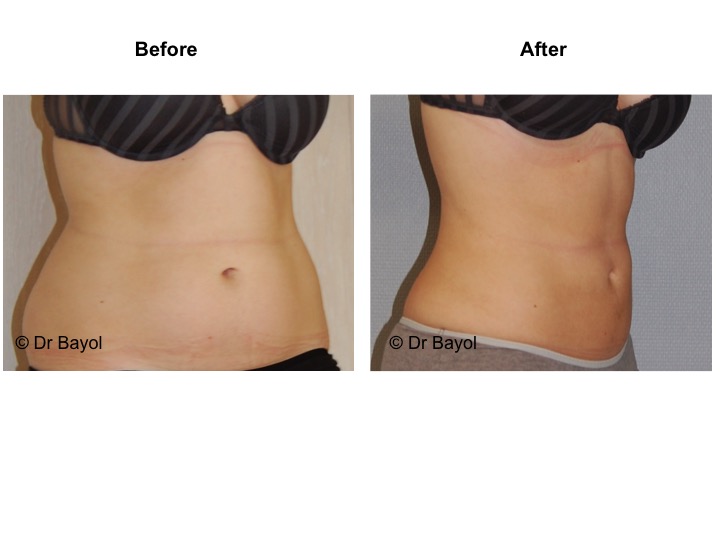 liposuction lausanne
