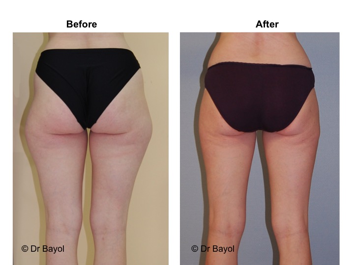 liposuction switzerland