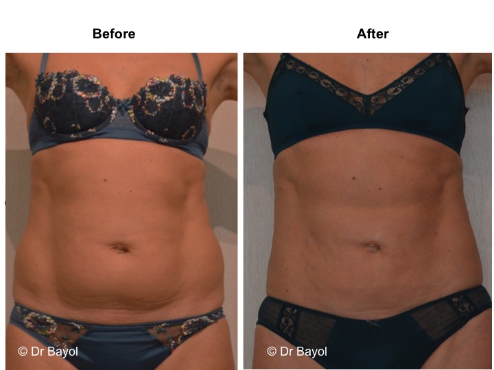 lipoaspiration a geneve