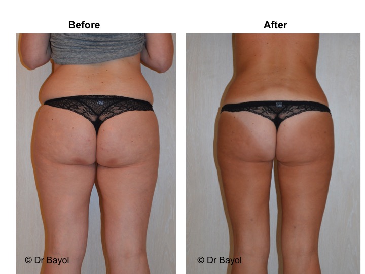 lipoaspiration geneve