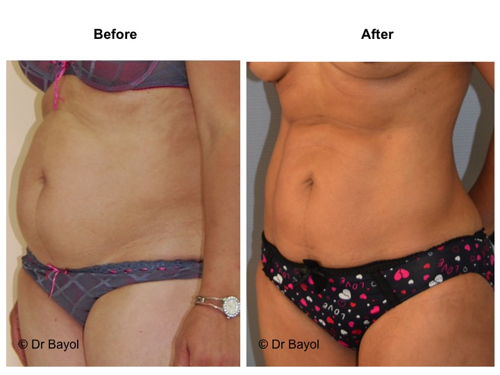 lipoaspiration a lausanne
