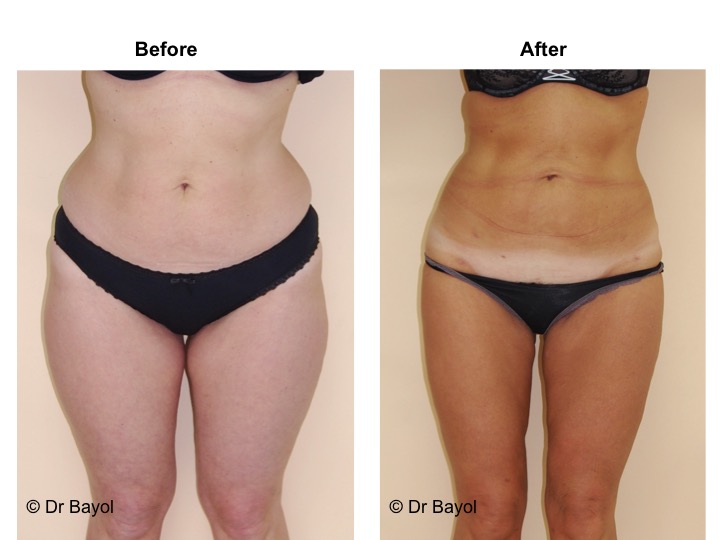 traitement liposuccion geneve