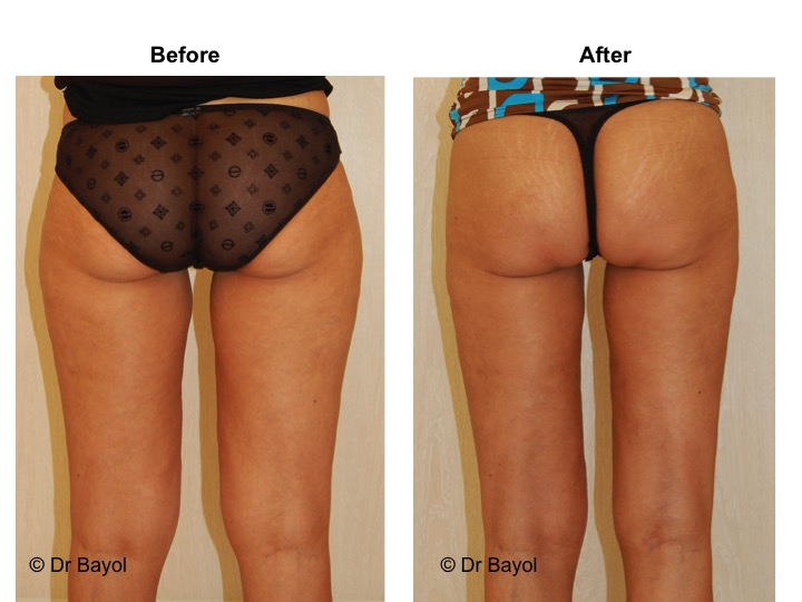 liposuccion lausanne