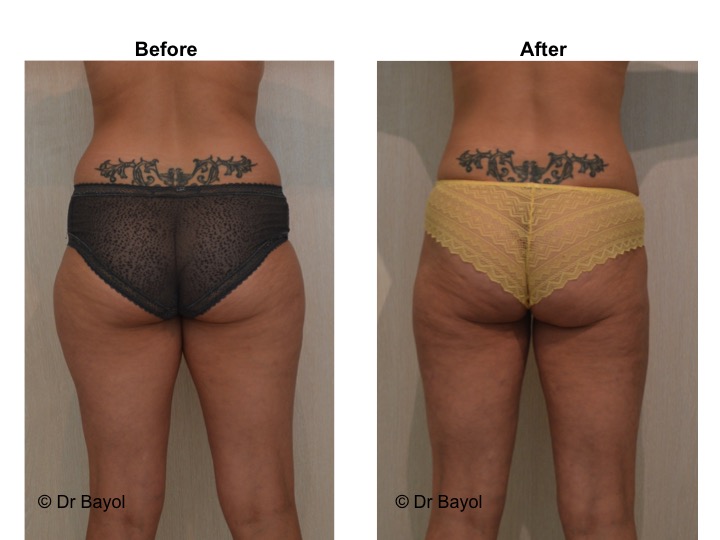 liposuction in geneva