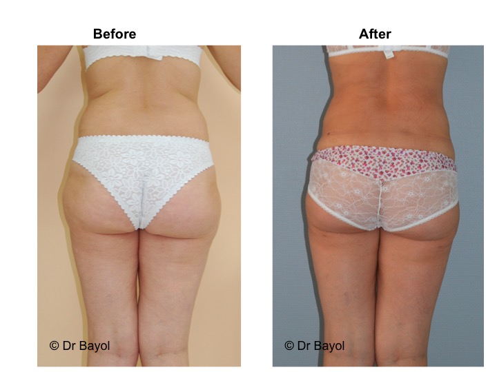 lipoaspiration geneve