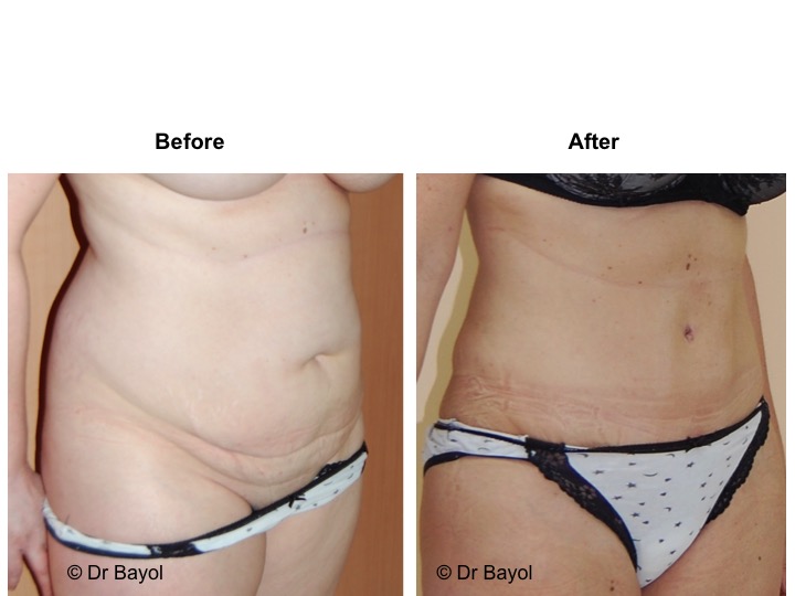 abdominoplastie genève