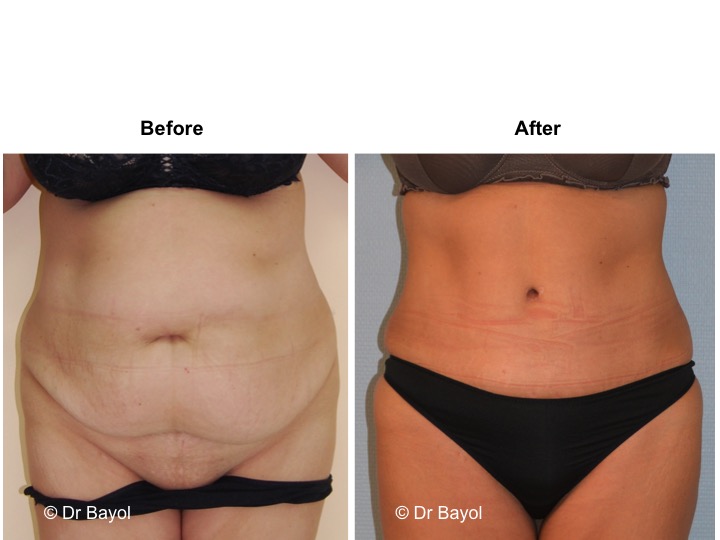 abdominoplastie lausanne