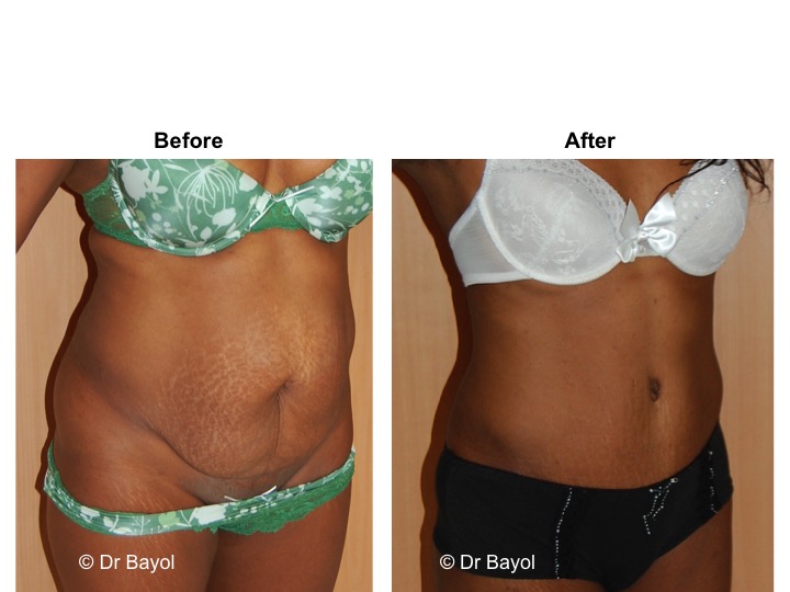 abdominoplastie suisse