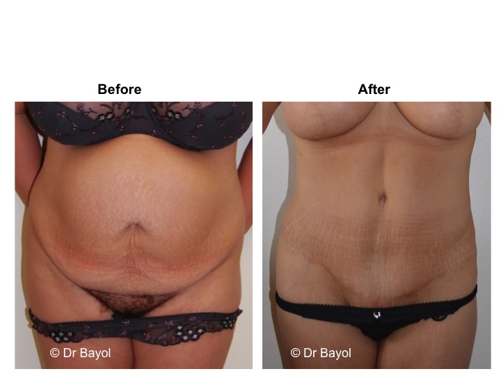 chirurgie esthetique ventre genève