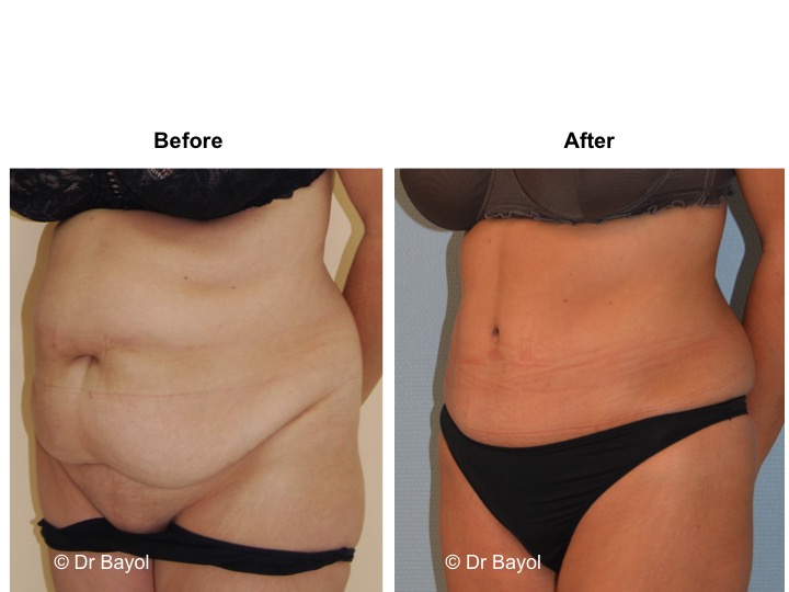 chirurgie esthetique ventre lausanne
