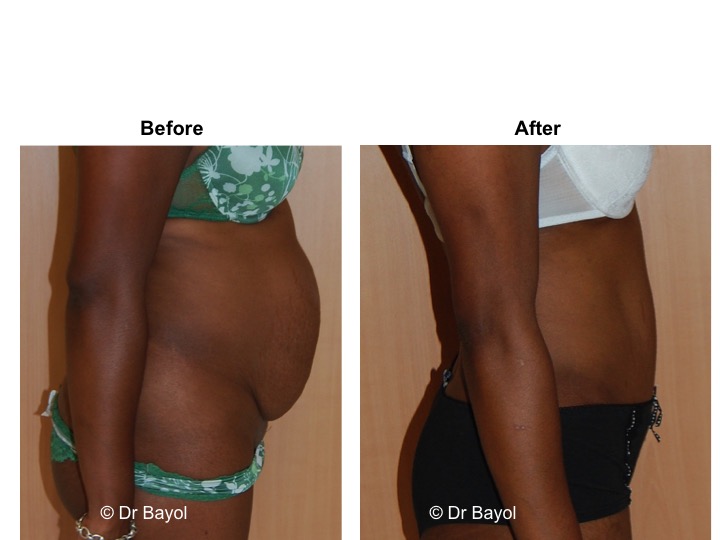 chirurgie esthetique ventre suisse