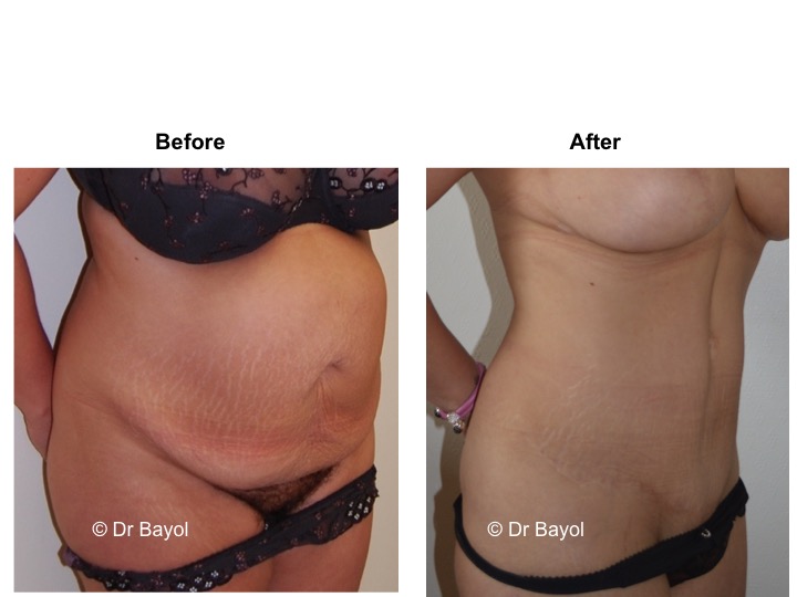 plastie abdominale lausanne
