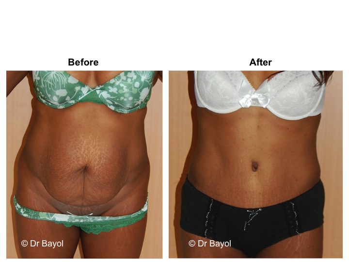 plastie abdominale suisse