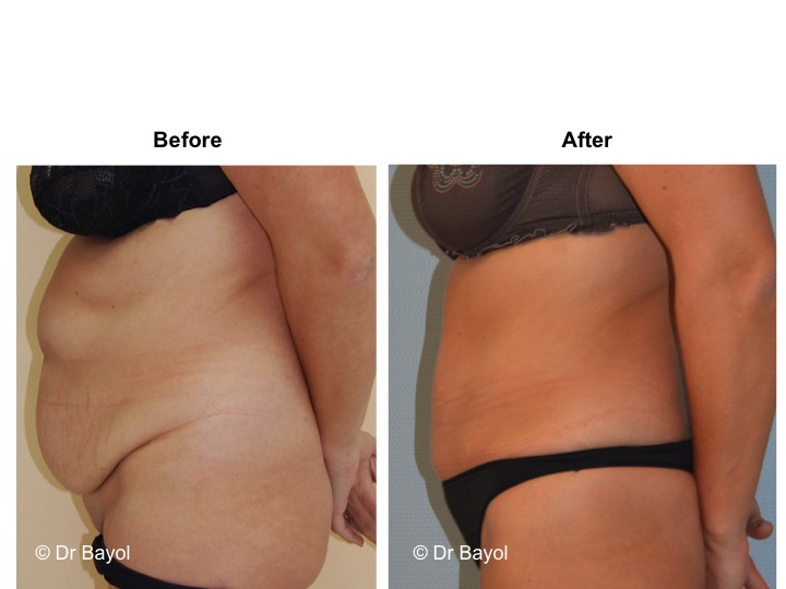 tummy tuck geneva