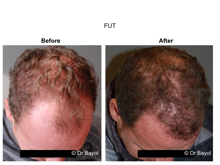Micro greffe de cheveux fut et fue, implants capillaires - geneve et