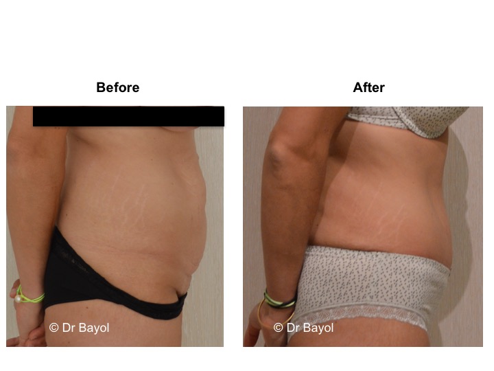 abdominoplasty lausanne