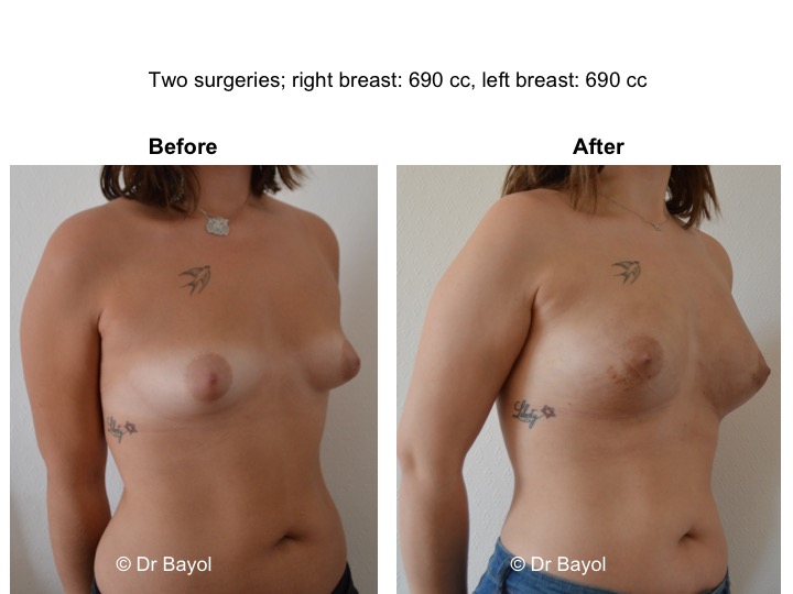 augmentation mammaire sans implants lausanne