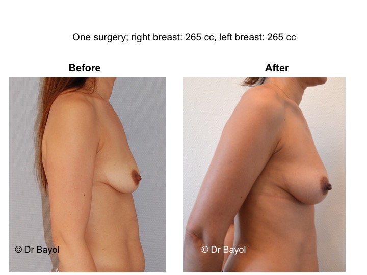 augmentation mammaires sans prothèses suisse