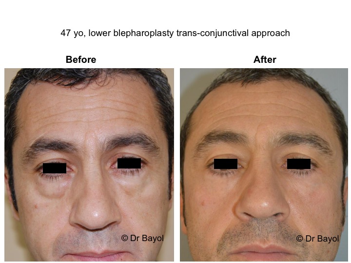 blépharoplastie inférieure lausanne