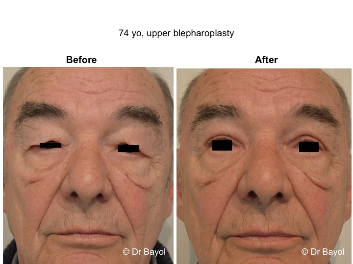 blépharoplastie supérieure genève