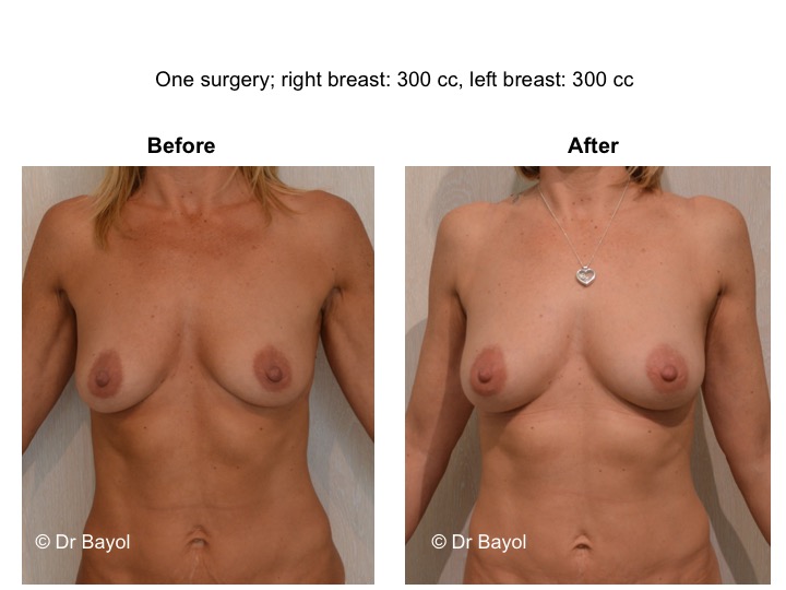 breast lipofilling geneva