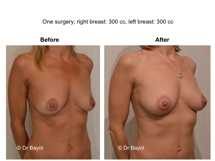 breast lipofilling lausanne