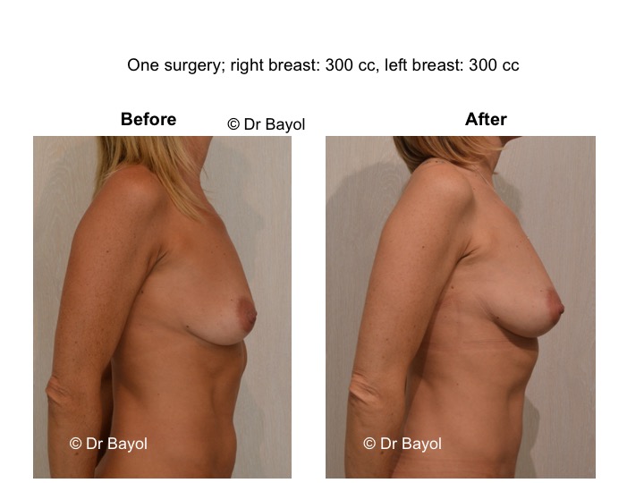 breast lipofilling switzerland