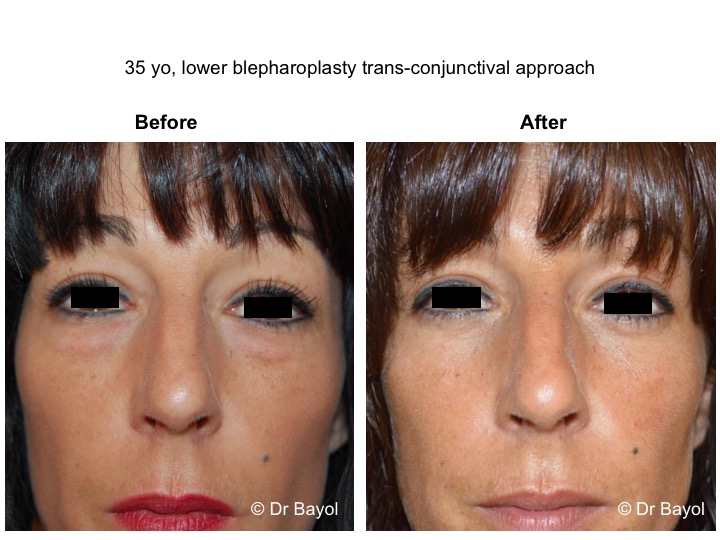 lower blepharoplasty geneva