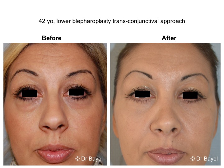 lower blepharoplasty lausanne