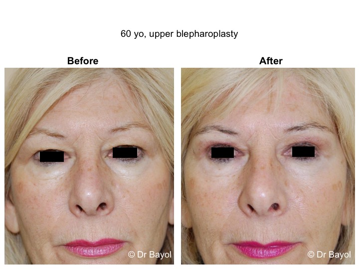 upper blepharoplasty lausanne