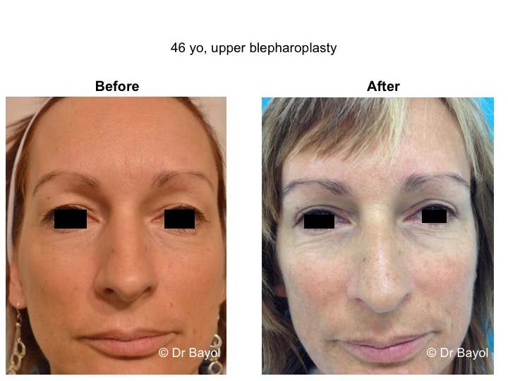 upper blepharoplasty switzerland