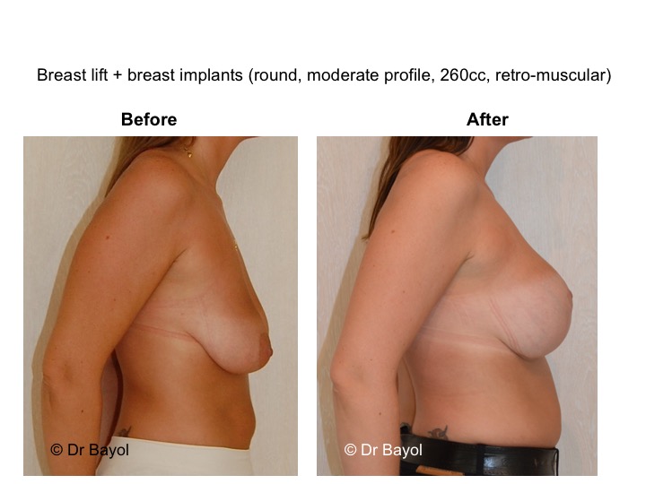 breast lift geneva