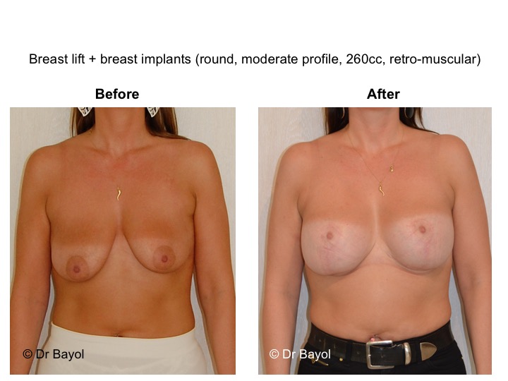 breast lift switzerland