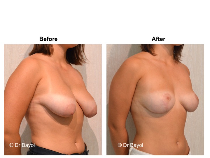 lifting seins lausanne