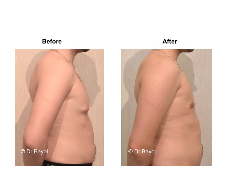 best plastic surgeon gynecomasty geneva