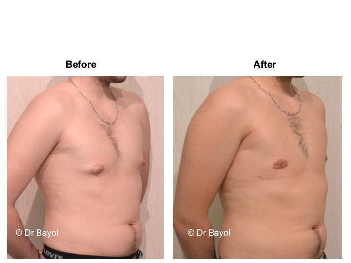 best plastic surgeon gynecomasty lausanne