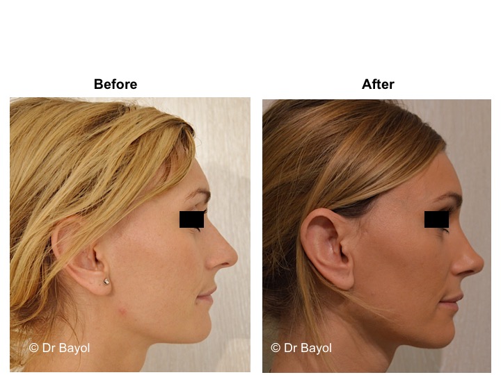 bon chirurgien esthétique rhinoplastie genève