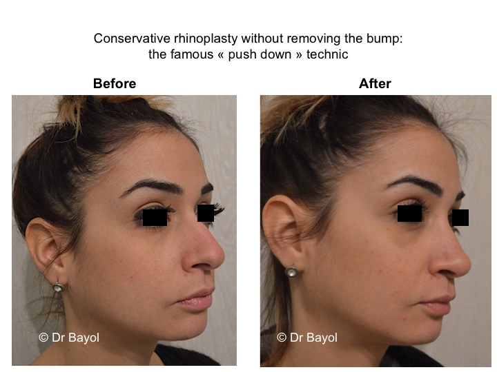 bon chirurgien esthétique rhinoplastie lausanne