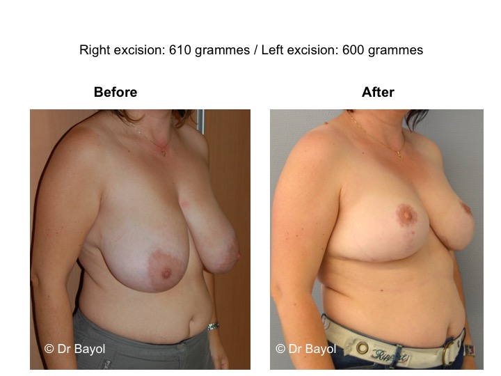 breast reduction