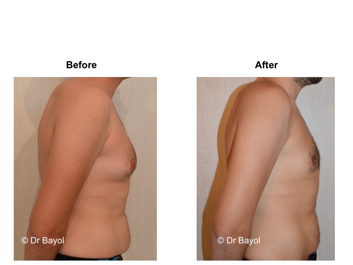 gynecomasty geneva