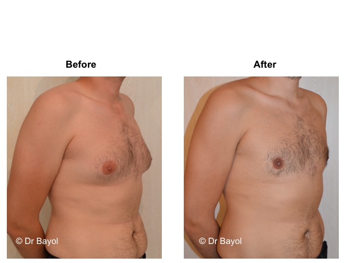 gynecomasty lausanne