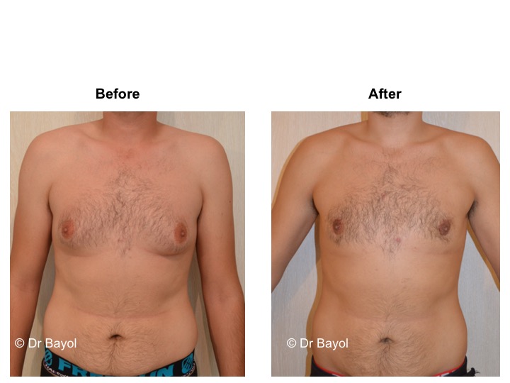 gynecomasty switzerland