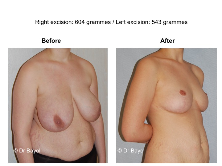 mammoplasty geneva