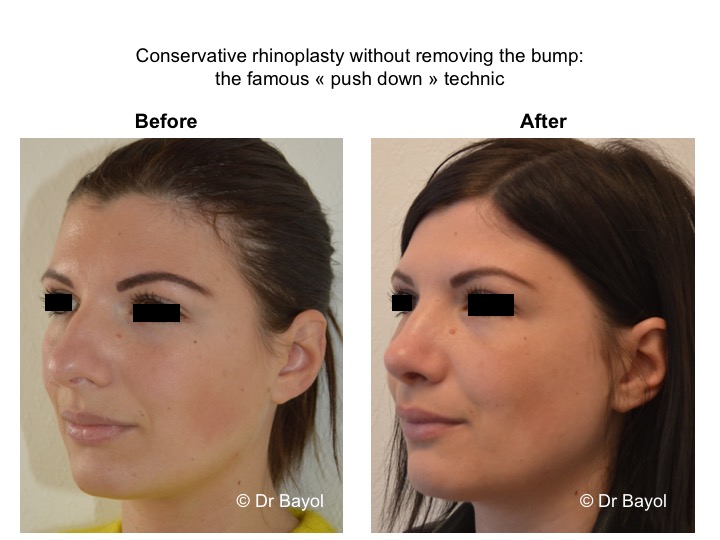 meilleur chirurgien esthétique rhinoplastie lausanne