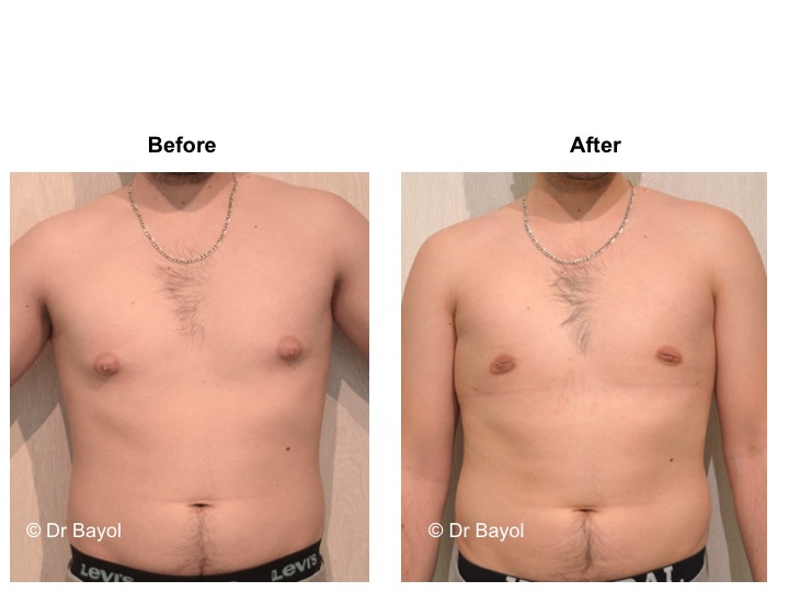 price gynecomasty geneva