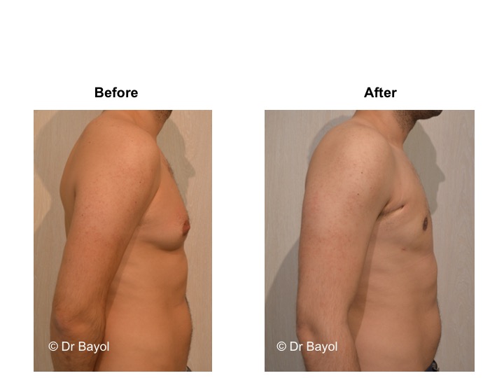 price gynecomasty lausanne