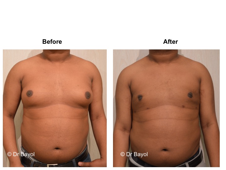 prix cure gynecomastie lausanne