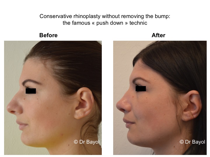 tarif rhinoplastie genève