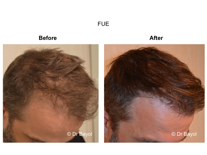 hair graft FUE Lausanne